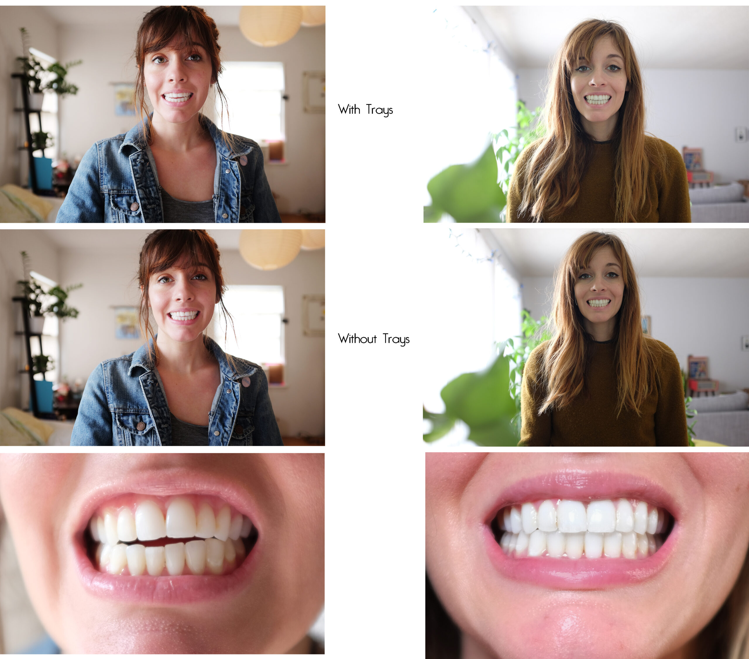 invisalign before after scaled