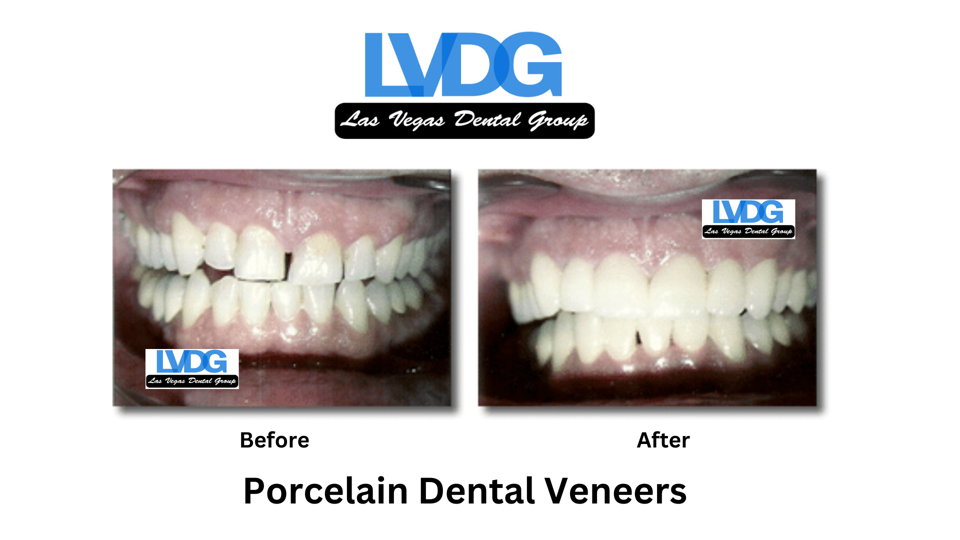 veneers las vegas