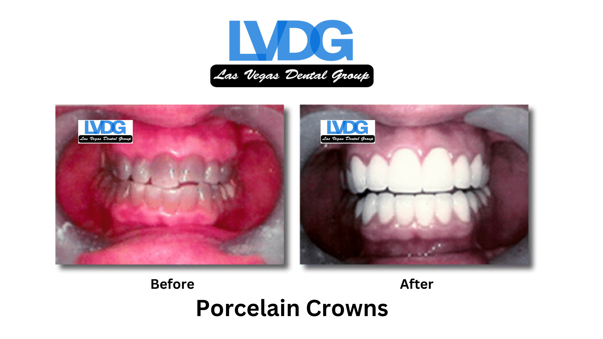 Porcelain Crowns Las Vegas Dental Group