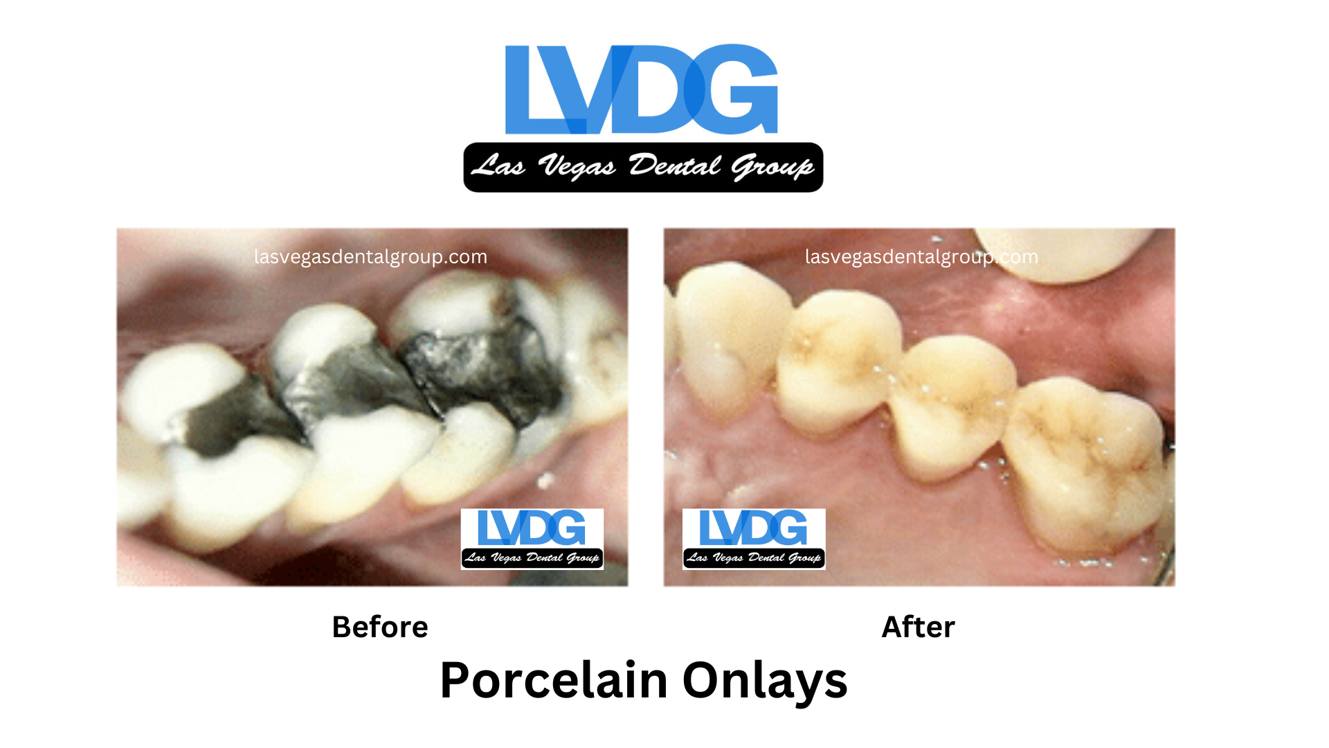 porcelain onlays Las Vegas Dental