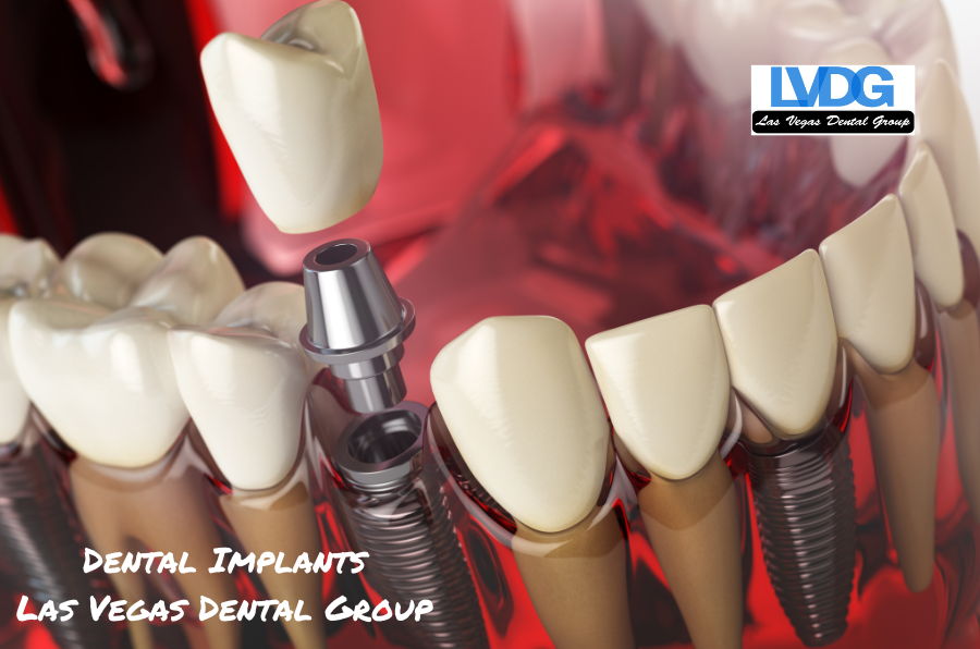 dental implants las vegas