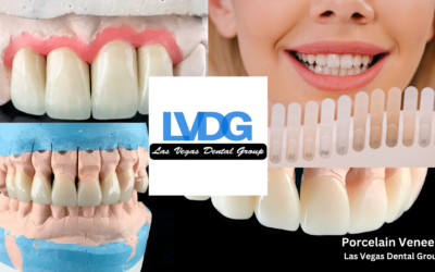 Porcelain Veneers Las Vegas Dental Group | Premier Cosmetic Dentistry