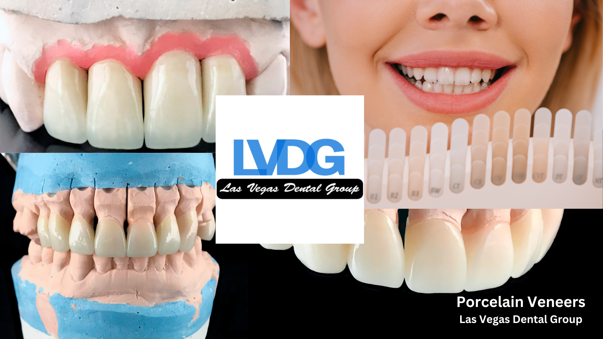 Porcelain Dental Veneers Las Vegas 