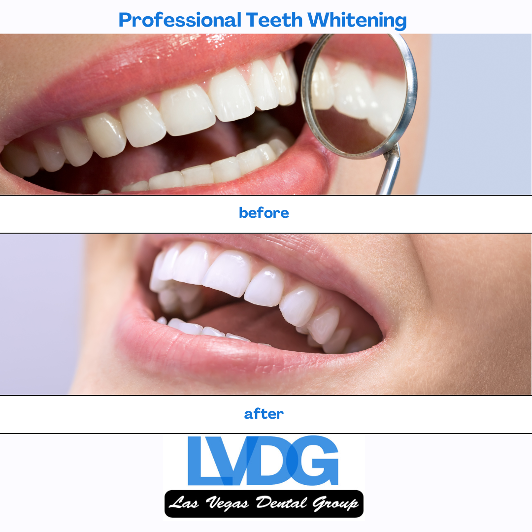 Teeth Whitening Las Vegas Dental Group